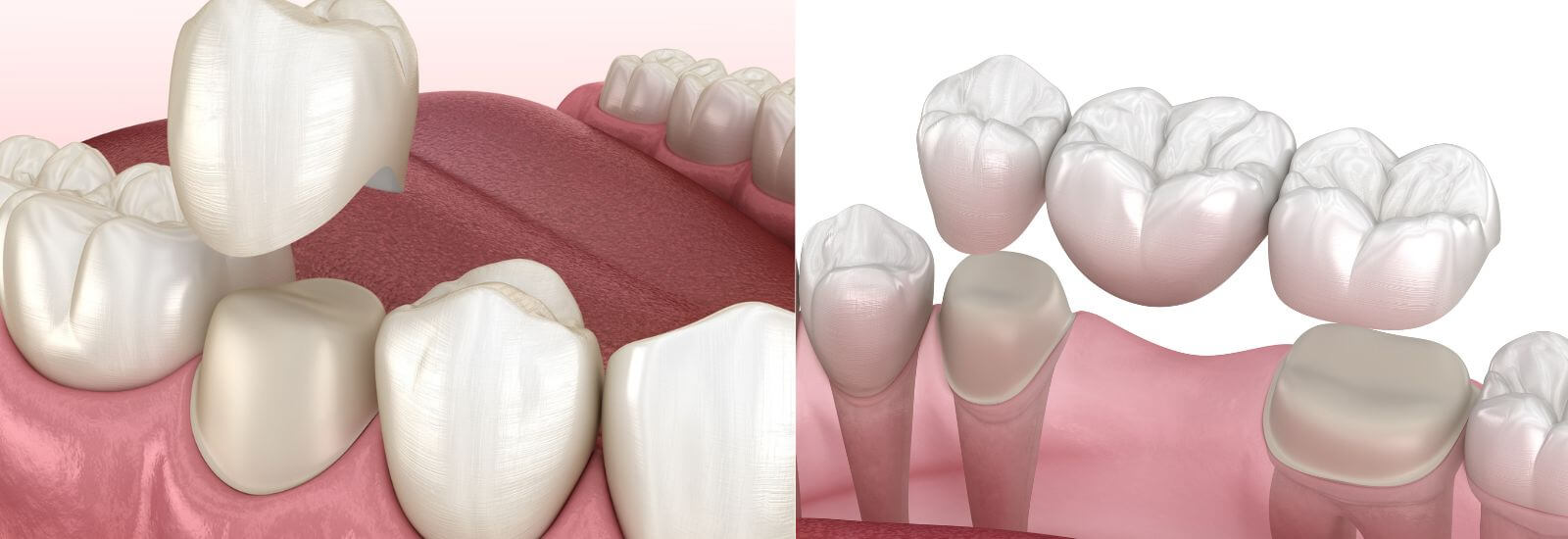 Dental crown and bridges