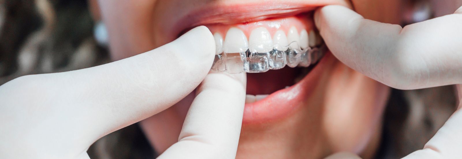 Dentist inserting an Invisalign to a patient